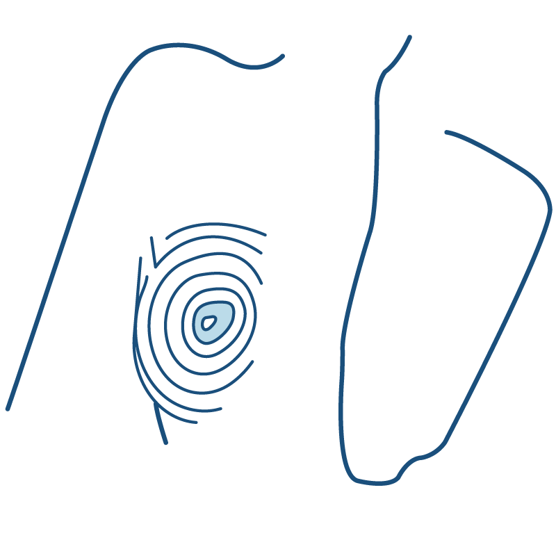Nipple Areolar complex